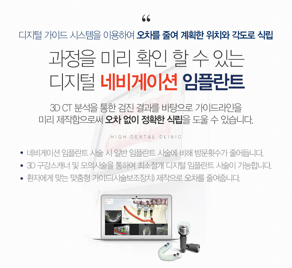 과정을 미리 확인 할 수 있는 디지털 네비게이션 임플란트